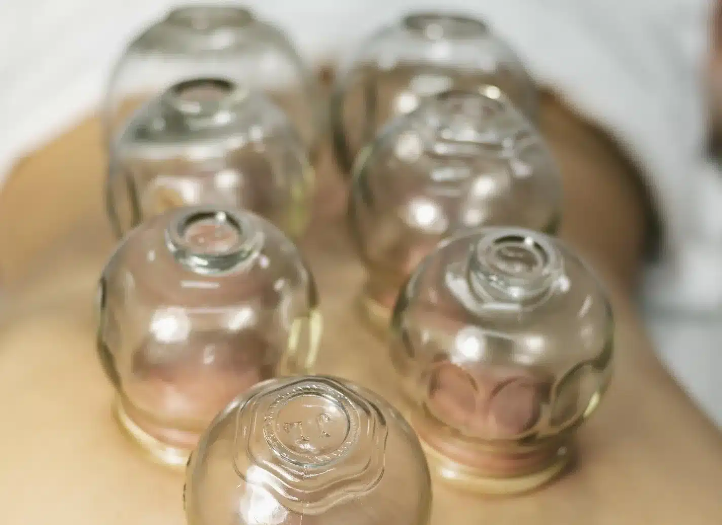 pose de ventouses sur le dos