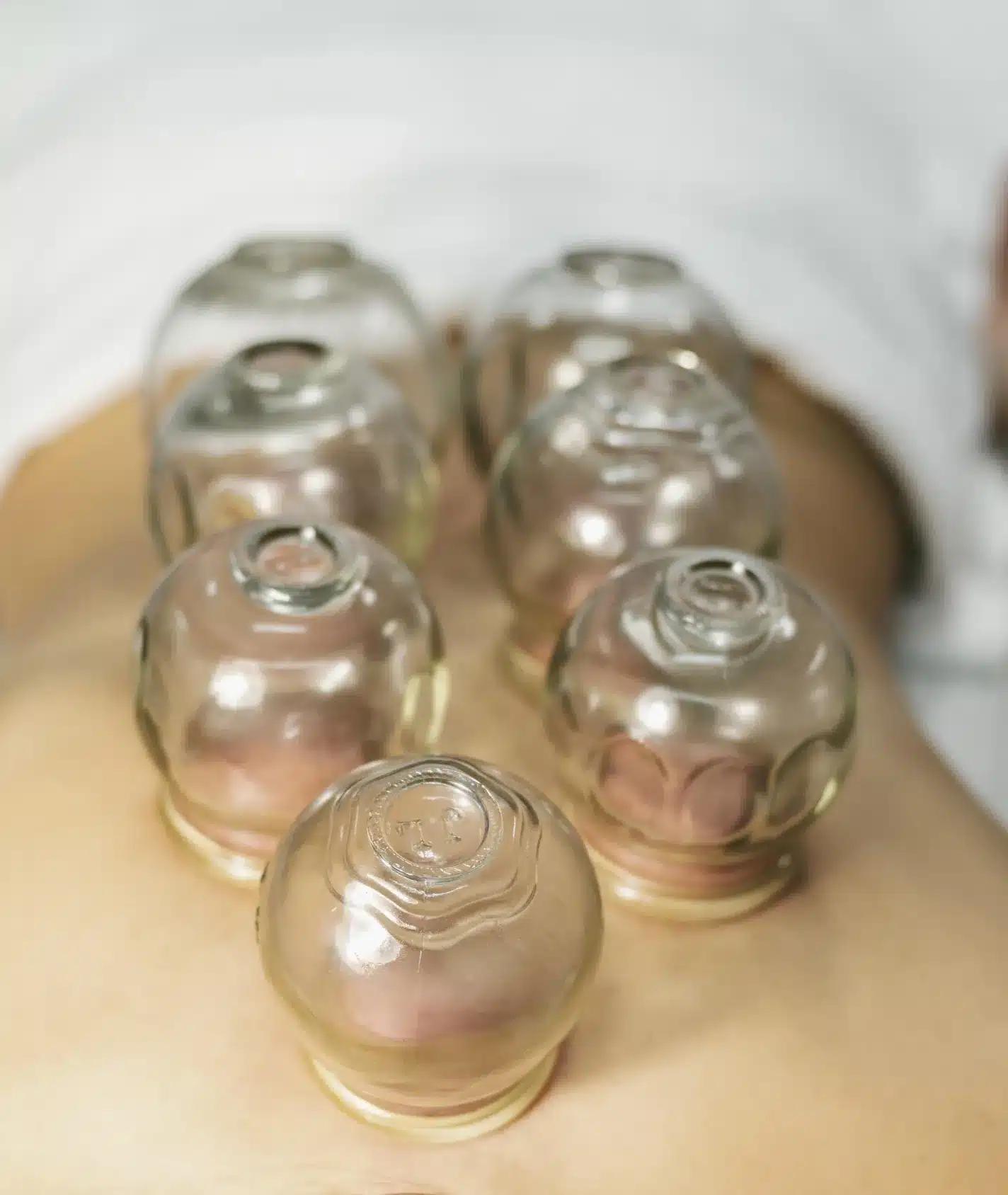 pose de ventouses sur le dos